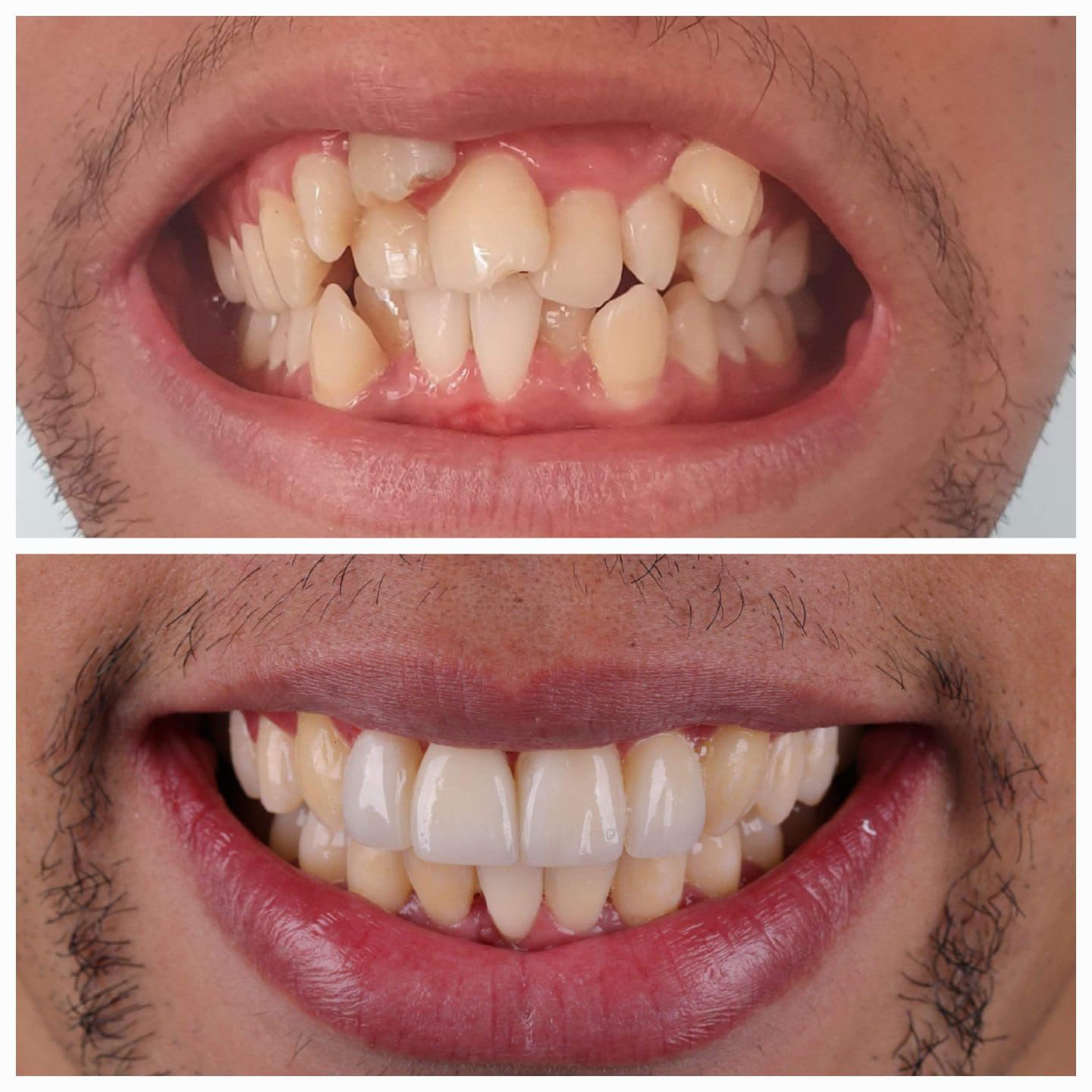 Sorriso antes das facetas em resina composta