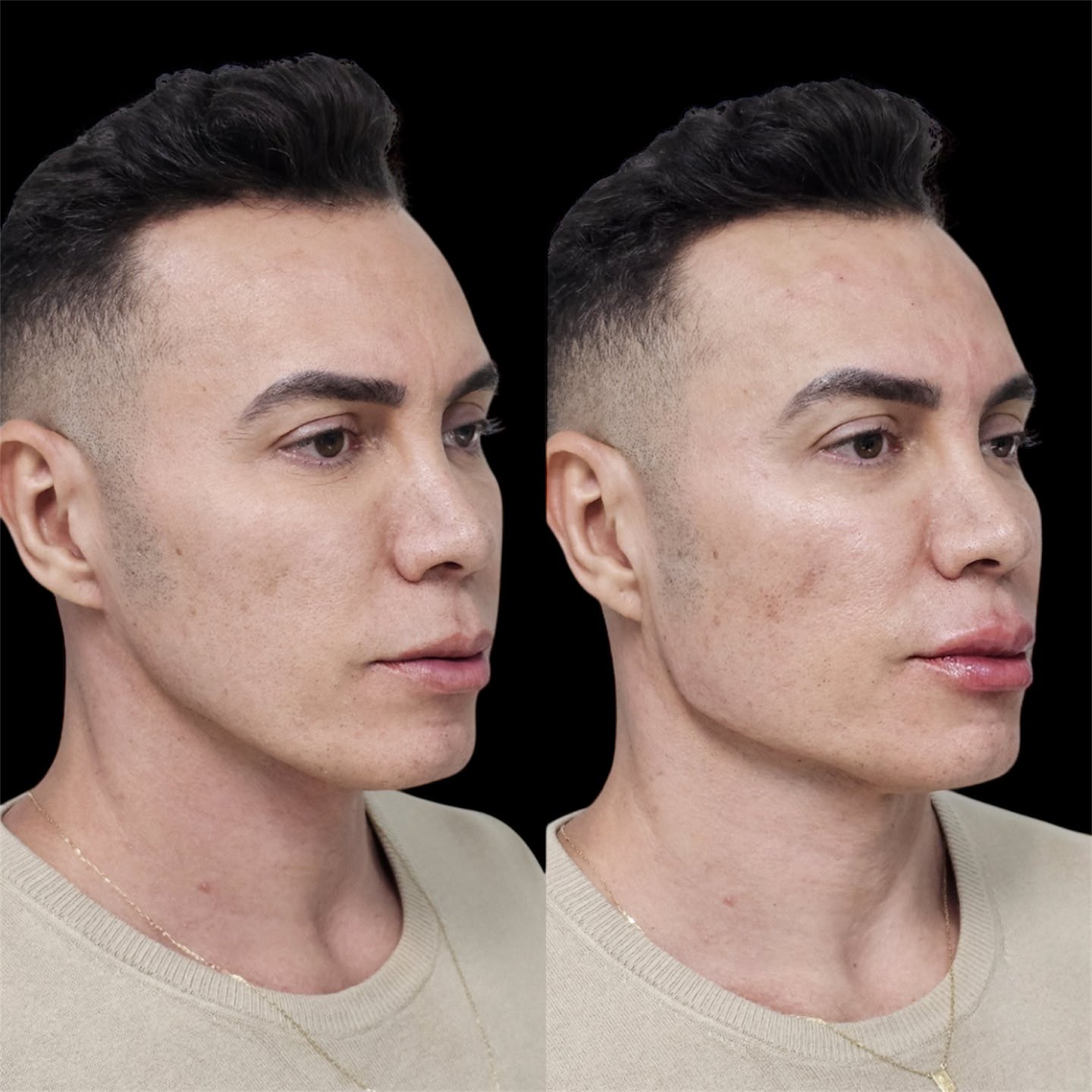 Resultado de harmonização orofacial