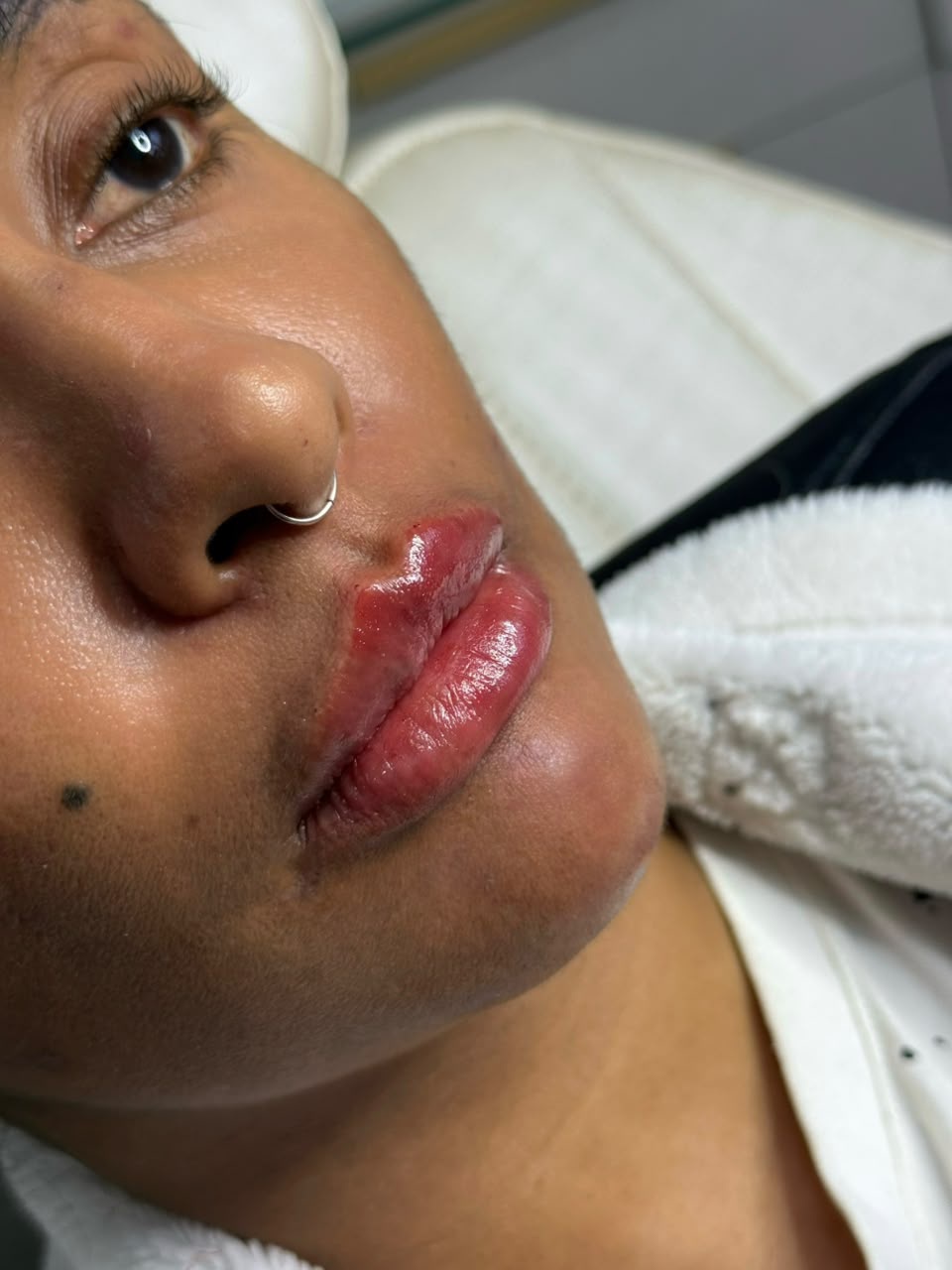 Lábios antes do preenchimento labial
