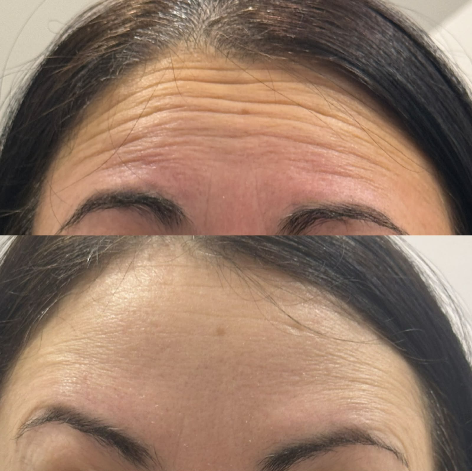Resultado da aplicação de toxina botulínica na região frontal