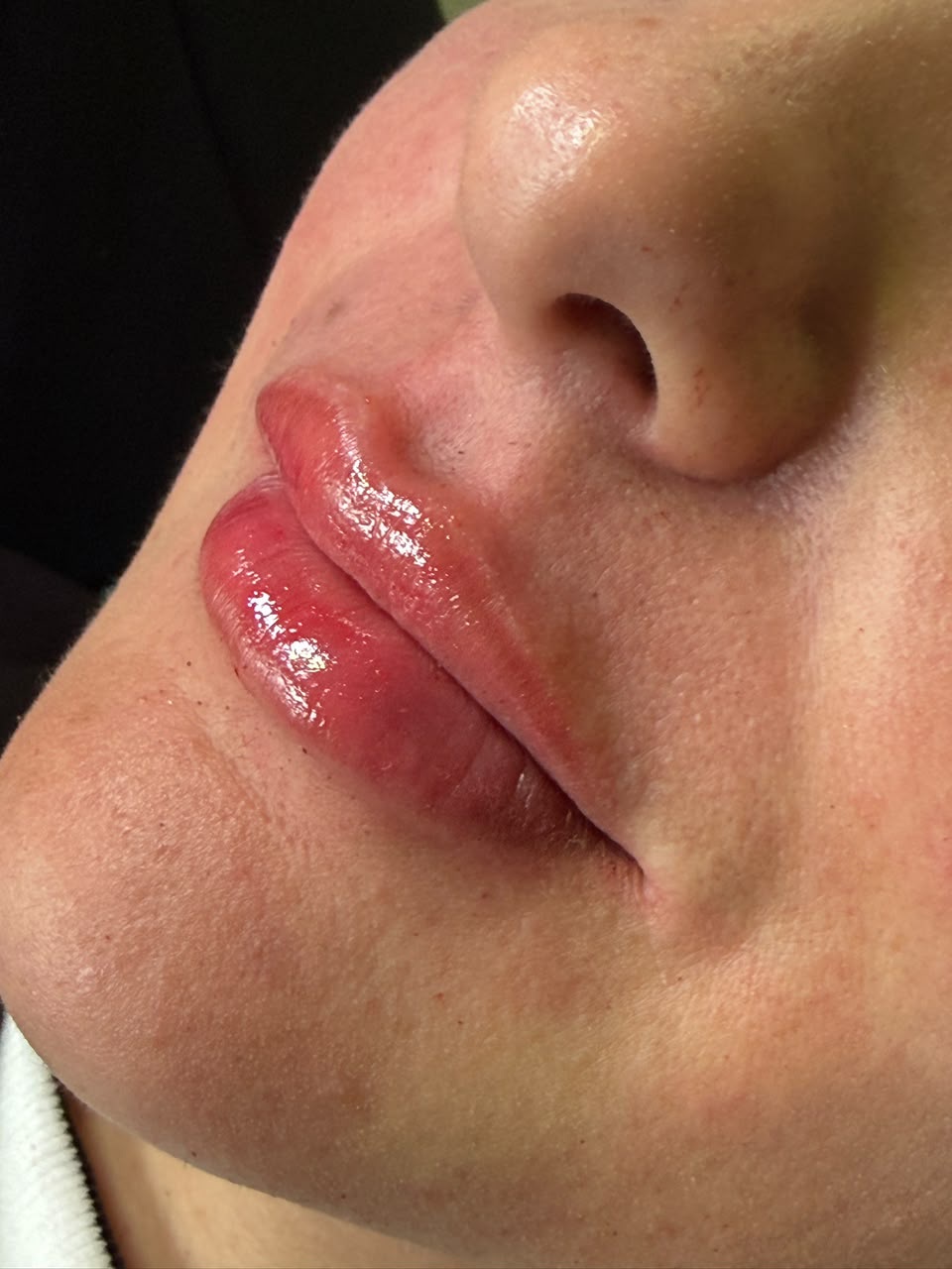 Resultado do preenchimento labial